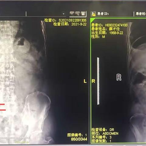 不一样的上消化道穿孔手术