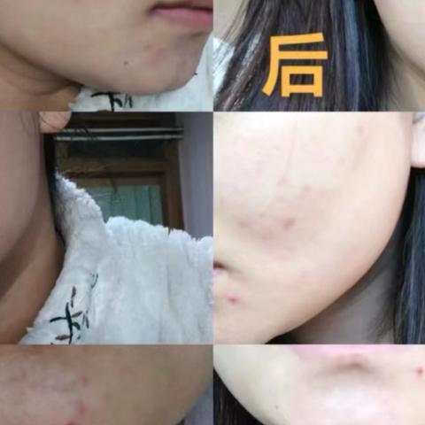为什么一直在祛痘，痘痘却还是不停的疯长？