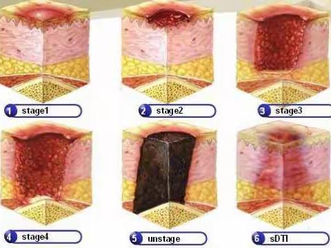 压疮的预防