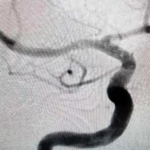 20221026 TYH 56Y M MCA经桡大脑中动脉支架