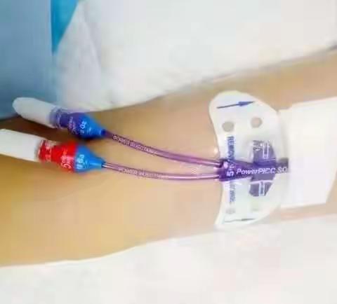 肿瘤科成功开展末端瓣膜式注射型PICC置管术