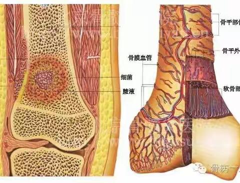 青海康乐医院个性化手术治疗，助骨髓炎患者恢复健康！