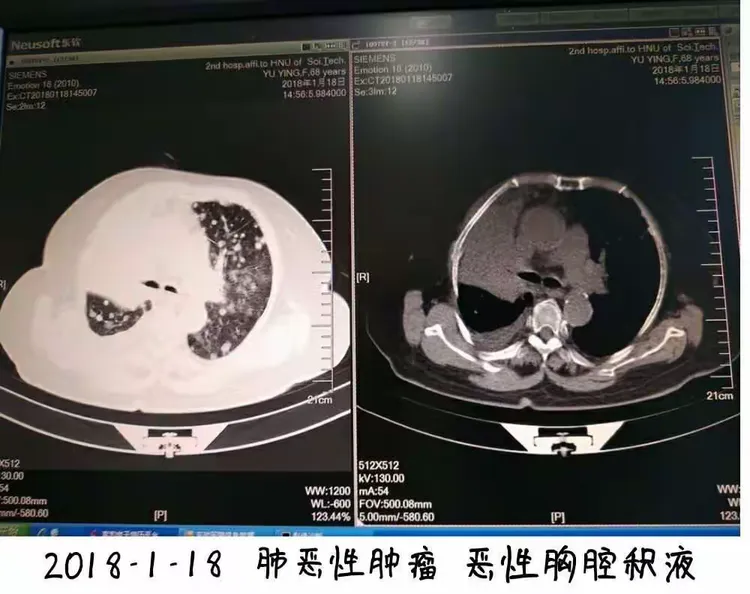 胸部肿瘤综合治疗之一肺癌篇～～～科大二附院胸外科胡举副主任医师治疗体会