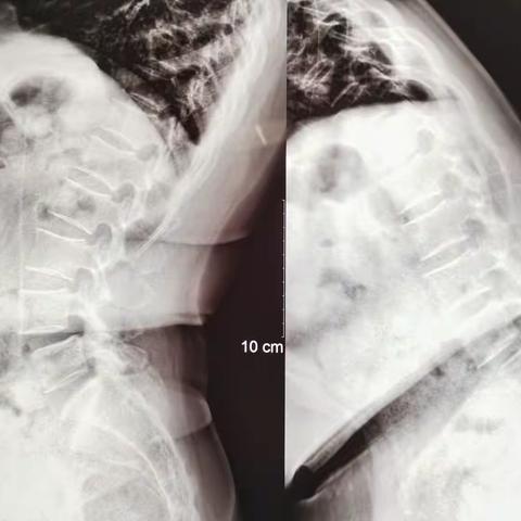 腰不疼了，脚不麻了，问题解决了！