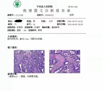经肛门局部切除手术治愈1例早期直肠癌