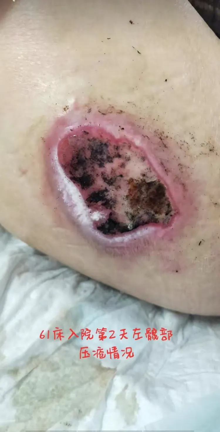 你知道怎样能让压疮好的更快吗