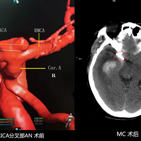 半月谈神外AN—EC+MC（动脉瘤栓塞+开颅夹闭）