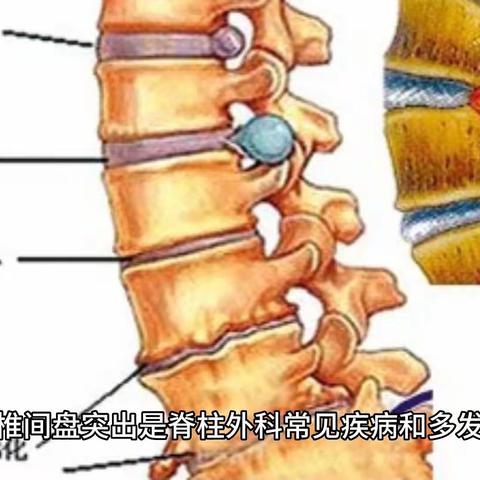 疾病科普之腰椎间盘突出