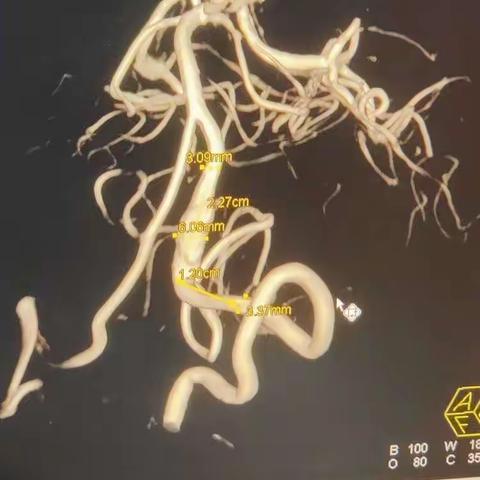 12.19 山东省立医院 冯斌 椎动脉夹层动脉瘤 tb 4035