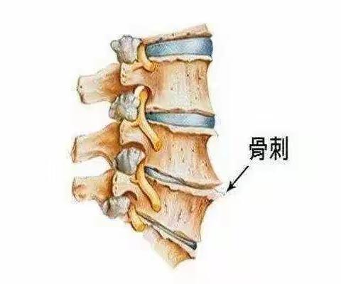 "骨刺"不是病，今天我为骨刺正名