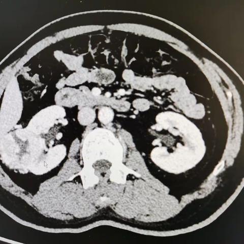 分享经后腹腔镜肾癌根治一例