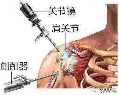 方寸之间，精益求精----甘州区人民医院外二科成功实施全院首例肩关节镜微创手术