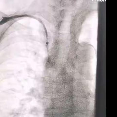 导管在手,成功在我