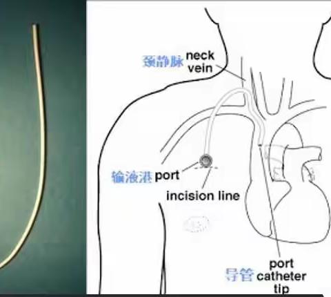 输液港如何植入？ 带您了解输液港植入过程