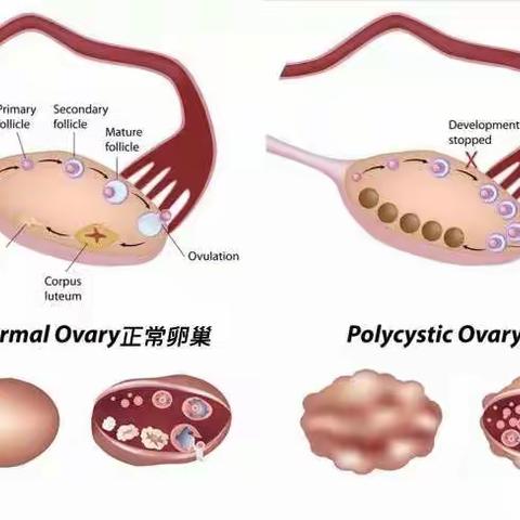 二甲双胍用于多囊卵巢综合征？