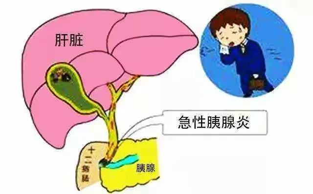 16.急性胰腺炎