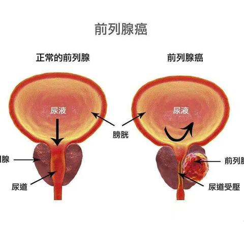 前列腺癌的早期筛查