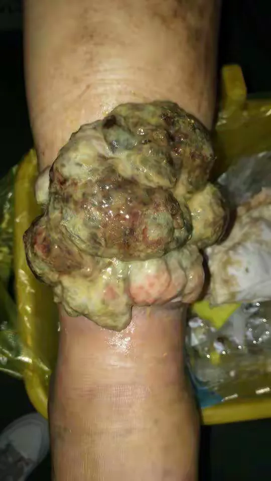 小腿梭形细胞恶性肿瘤,恶臭无比.整形外科扩大切除肿瘤,皮瓣移植修复