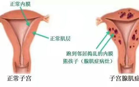 上京科普|子宫腺肌症到底是什么？