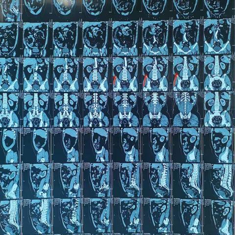【新技术】我院泌尿外科在昆明附二院泌尿外科李志鹏主任指导下完成首例腹腔镜下膀胱全切原位肠代膀胱术