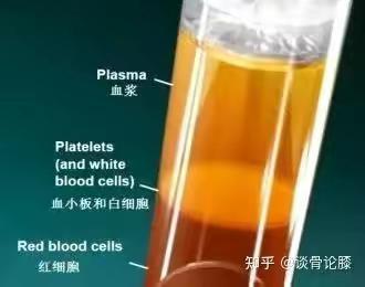 骨关节炎不用怕，富血小板血浆是妙招！—娄底市第三人民医院成功引进并运用PRP注射疗法！