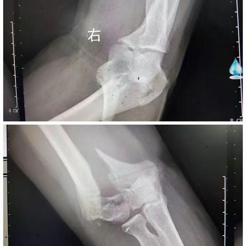三折肱,为良医！娄底市第三人民医院骨一科成功完成一例右肱骨远端粉碎性骨折切开复位内固定术！