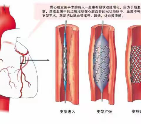 关心的问题—冠脉支架植入术