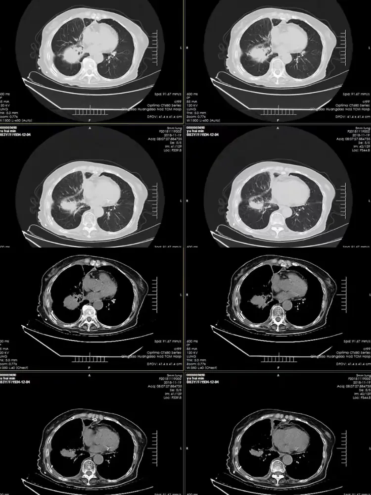 肺部的恶性肿瘤