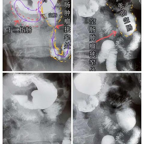 空肠支架植入治疗空肠恶性梗阻1例