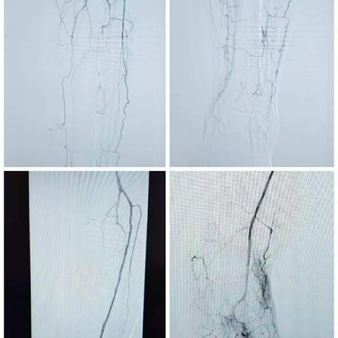 介入科A组血管病例报告5例：膝下动脉闭塞、肾动脉狭窄、腘动脉闭塞、下消化道大出血、下肢静脉曲张。
