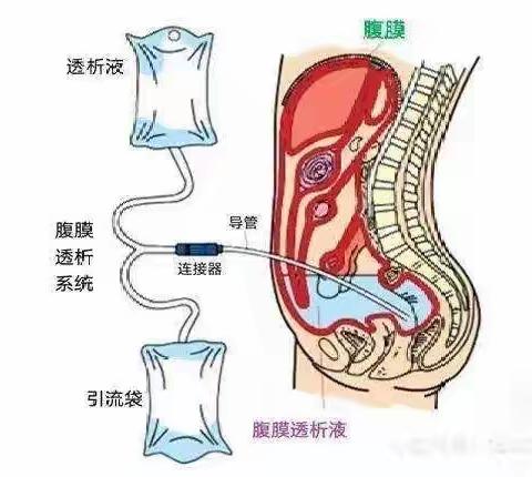 腹膜透析和血液透析哪个更好？