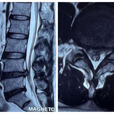 消失的“她”：腰椎间盘突出自发性吸收2例