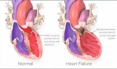 何为心力衰竭