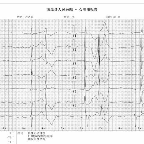 南漳县人民医院心内科完成了我院第一例心脏双腔起搏器置入术。