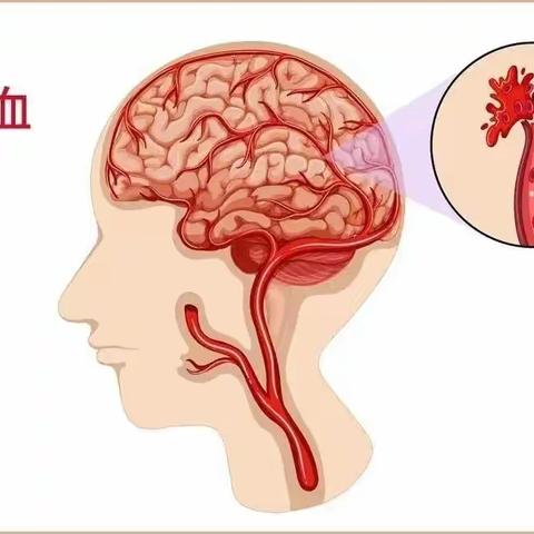 大名县中医院脑病一科齐卫敏——脑血管疾病的预防