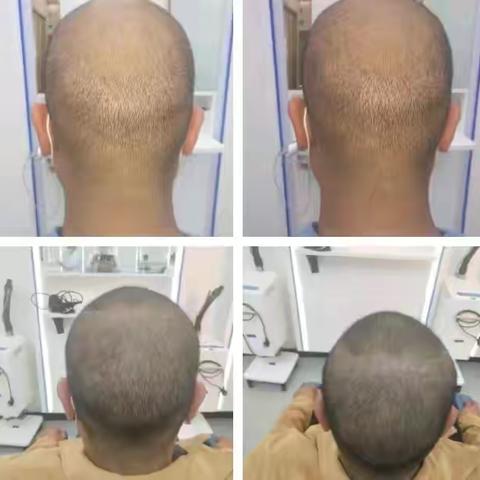 汕头哪家医院植发技术好？反馈好的华美植发价格表公布