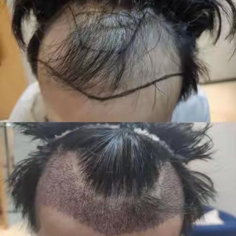 东莞哪家医院植发技术好？新生、雍禾植发费用和评价别错过