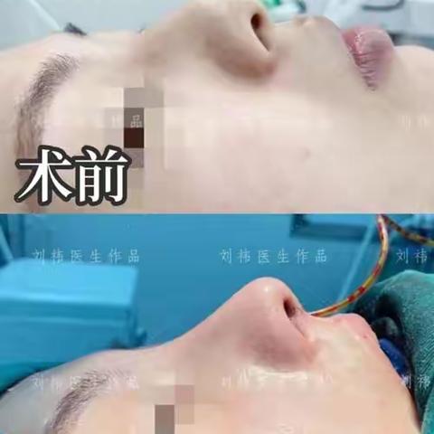 四川东篱医院正规吗？做眼鼻手术好的刘祎案例曝光