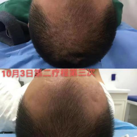 多事之秋，讲讲季节性脱发！镇平县人民医院皮肤科候主任为您解答！