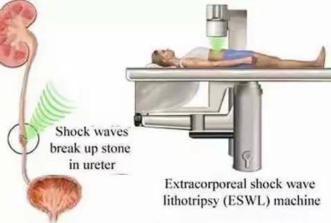体外冲击波碎石术后的健康管理