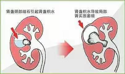 泌尿系结石是不是越大越严重？更要警惕结石引起的危害