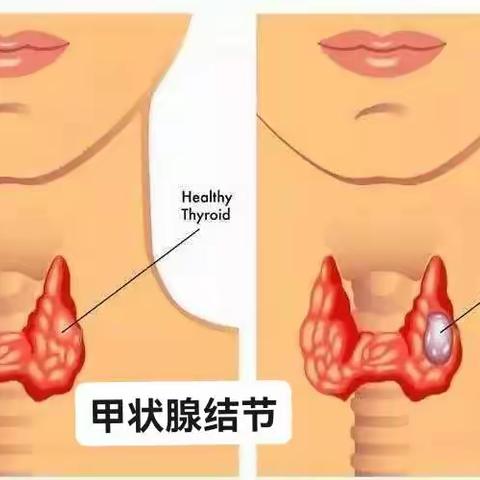 享甲状腺结节知识