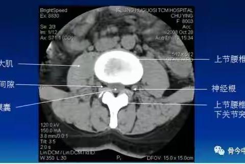腰椎的CT诊断（椎间盘突出、椎管狭窄、退行性改变） | 骨科基础