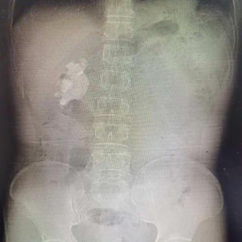 右侧经皮肾镜超声碎石取石术治疗右肾鹿角型结石