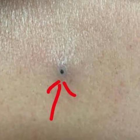 皮脂腺囊肿