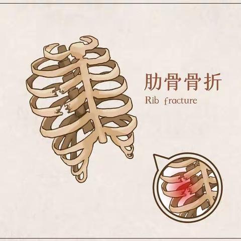 肋骨骨折