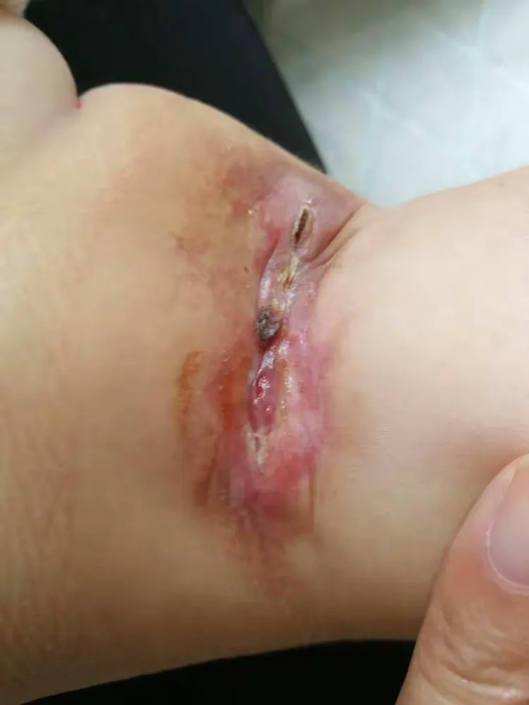 负压创面治疗,引领伤口愈合新方向