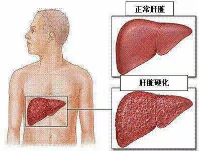 海东市高铁新区医院【科普】肝硬化的饮食与禁忌