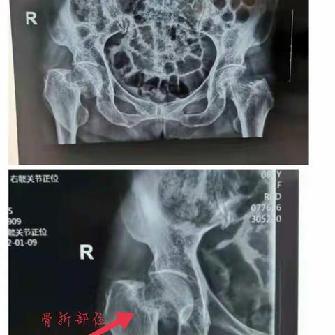 【微创动态】会泽县中医医院开展全县首例SuperPATH微创人工髋关节置换术