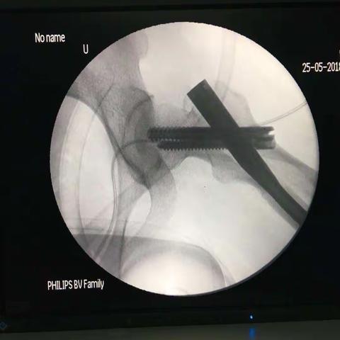 股骨上段粉碎性骨折闭合复位髓内钉内固定